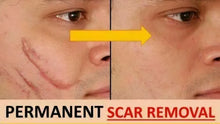 Load image into Gallery viewer, 2X MEBO SCAR Reduces Skin Formation After Surgery Injury or Acne
